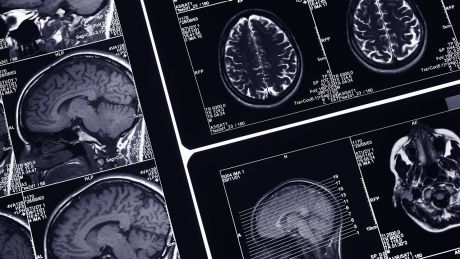 MRT-Aufnahmen eines menschlichen Gehirns © imago/Science Photo Library