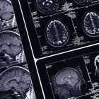 MRT-Aufnahmen eines menschlichen Gehirns © imago/Science Photo Library
